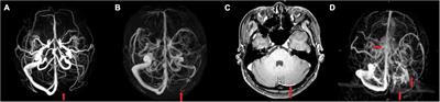 Anatomy imaging and hemodynamics research on the cerebral vein and venous sinus among individuals without cranial sinus and jugular vein diseases